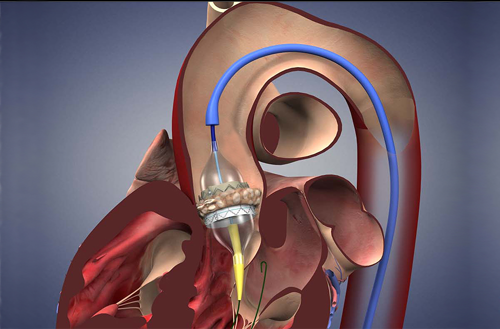 Illustration of transcatheter aortic valve replacement procedure.